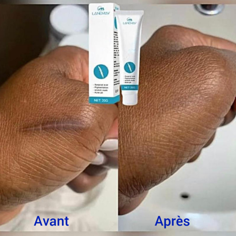 Élimine les tâches les cicatrices