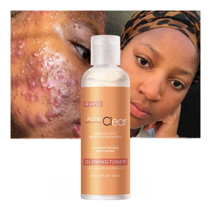Solution acnée, Lotion acnée, Lotion bouton, anti bouton, anti acné, anti tache